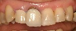 Porcelain-crowns-Before-Image